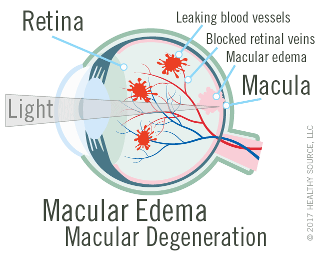 diagram of eye with macular edema and wet macular degeneration shows macula and retina, leaking blood vessels, In various clinical trials, all persons
      macular edema (swelling in macula), blocked retinal veins.