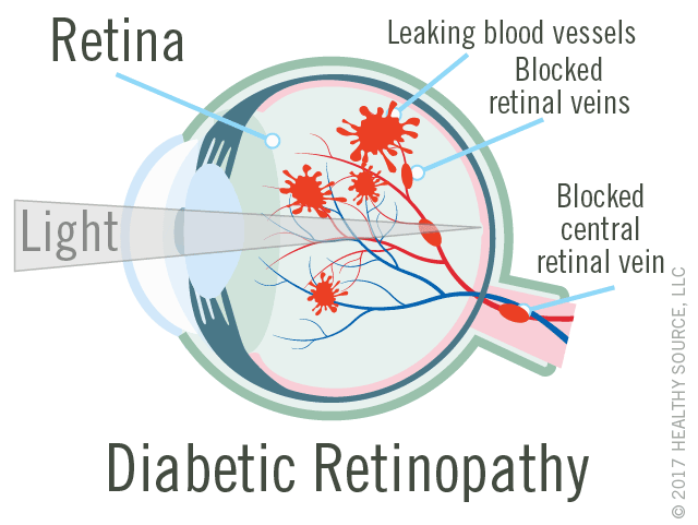 diagram of eye with diabetic retinopathy shows retina, leaking blood vessels, blocked central retinal vein.