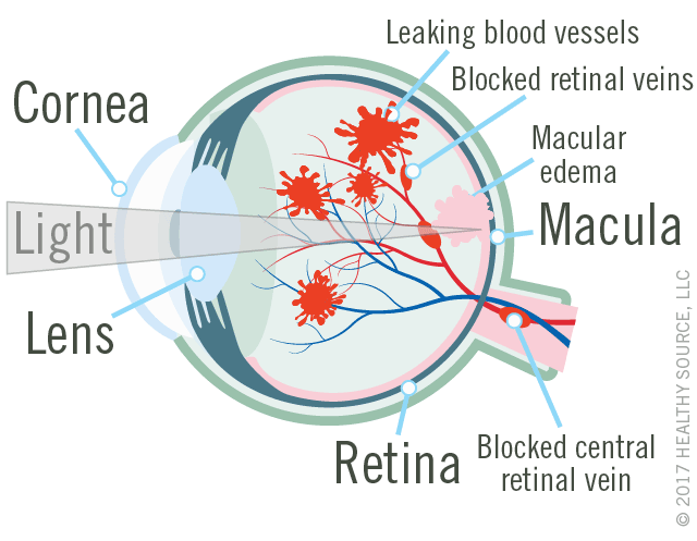 diagram of eye shows cornea, lens, macula and retina, leaking blood vessels, macular edema (swelling in macula), blocked central retinal vein.