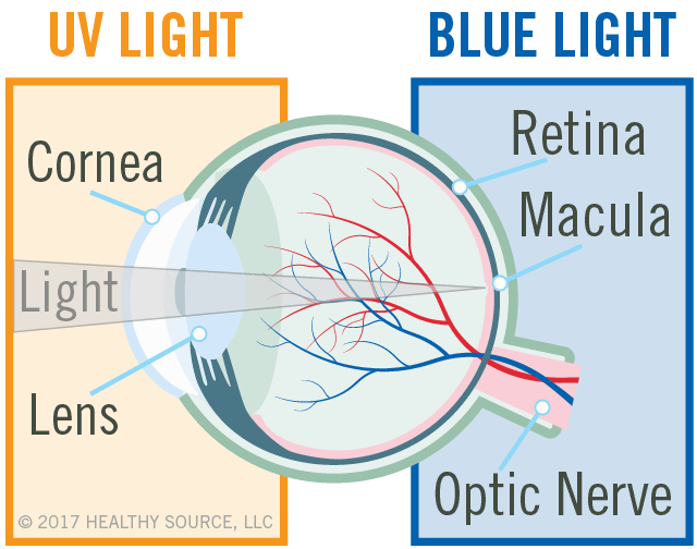 diagram of eye shows cornea, lens, macula and retina, leaking blood vessels, macular edema (swelling in macula), blocked central retinal vein.