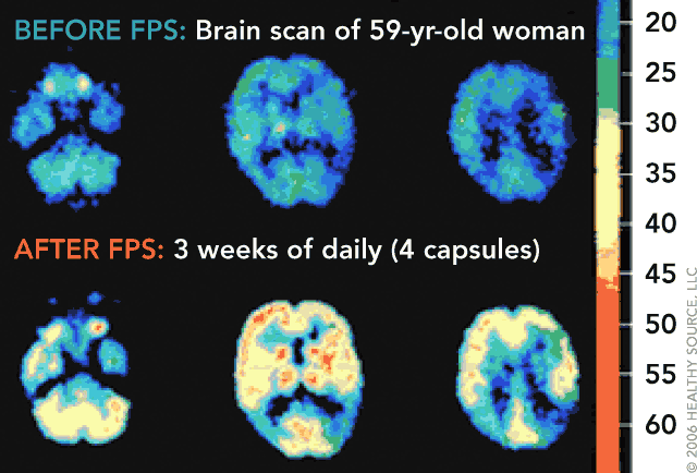 PET image of a 59-year-old female’s brain. The color scale indicates regional glucose metabolism at
                   three brain levels, red is most intense and tertiary is least. Upper: before Flavay Plus; Lower:
                   after Flavay Plus daily for three weeks.